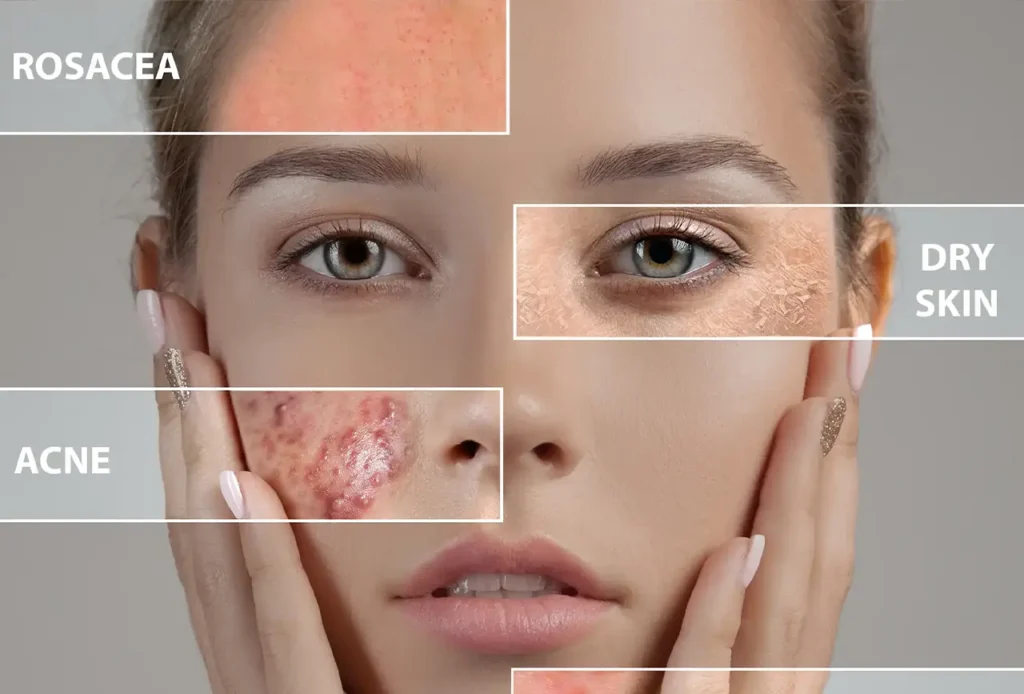 5 Benefits of Hypochlorous Acid for Your Skincare Routine