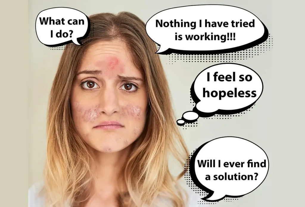 Hypochlorous Acid Spray and Acne